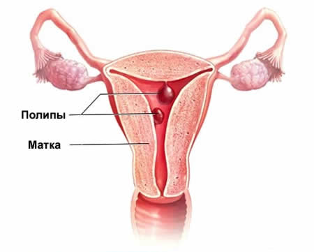 polip endometrium rák)