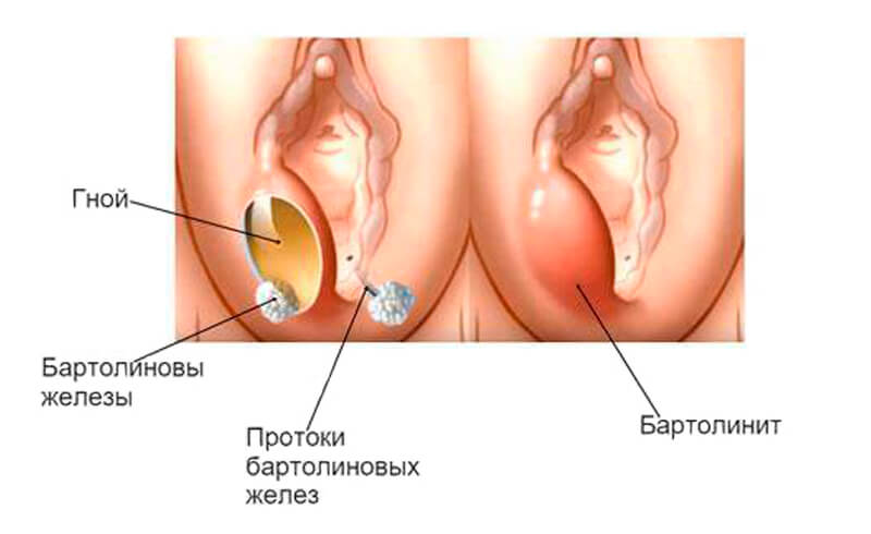 воспаление бартолиновой железы у женщин